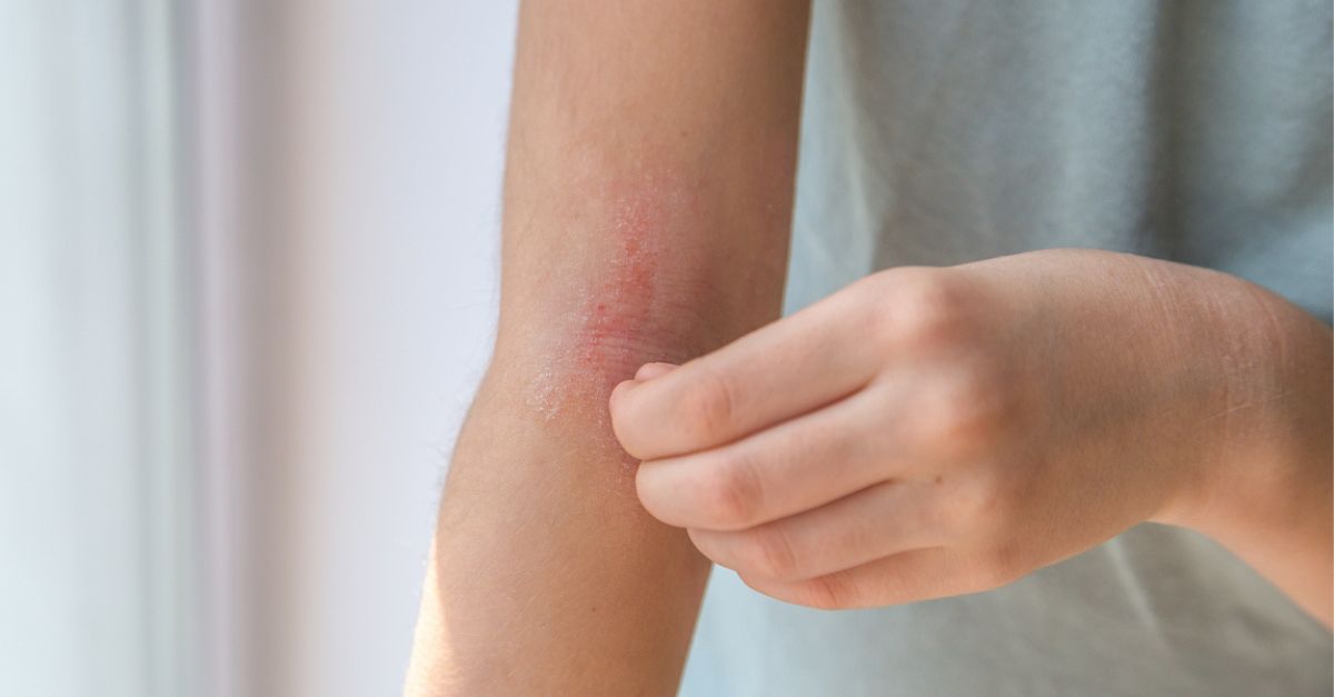 Frau kratzt sich am Arm, der auf der Haut Neurodermitis zeigt