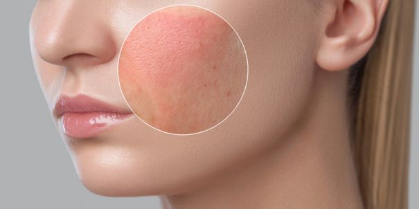 Das Bild zeigt ein Frauengesicht von der Seite und eine Hautstelle wird, wie unter einer Lupe, vergrößert dargestellt.