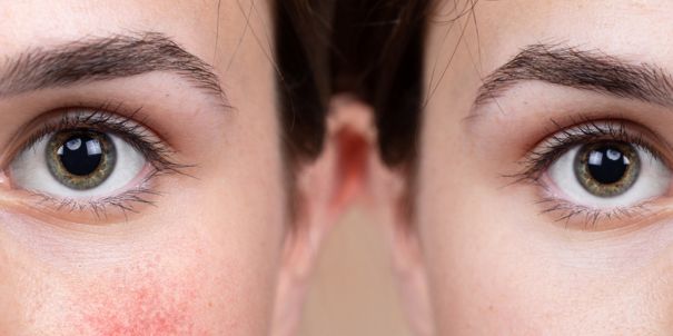 Was sind typische Merkmale sensibler Haut?